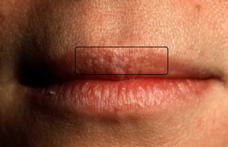 Cách chữa nổi hạt fordyce trên môi hiệu quả