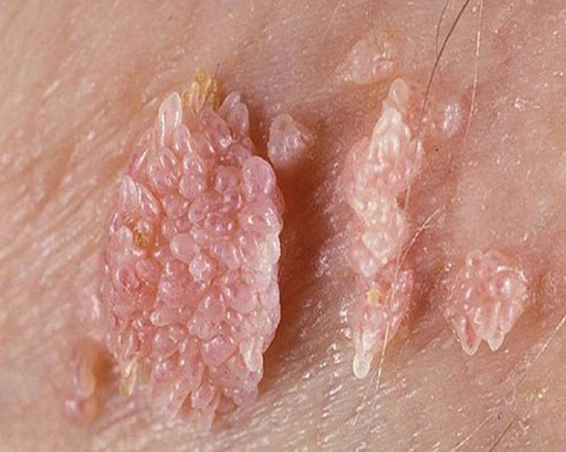 Mụn ở bao quy đầu: Nguyên nhân, biểu hiện và điều trị