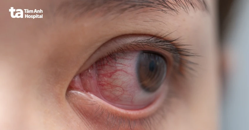 4 cách chữa rận mu tại nhà đơn giản, an toàn, hiệu quả triệt để