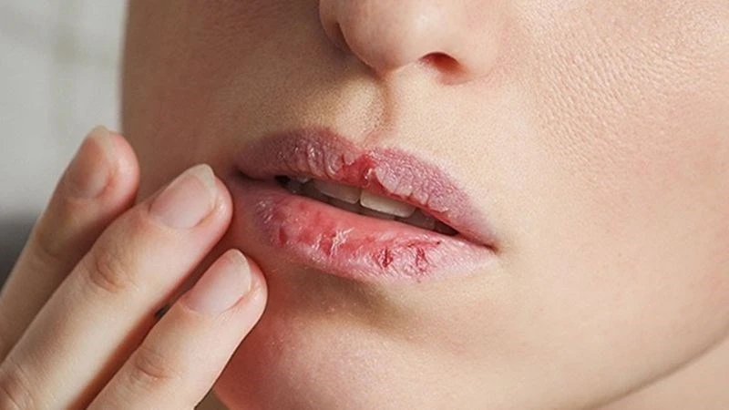 Cách giải nhiệt hiệu quả cho người nóng trong người