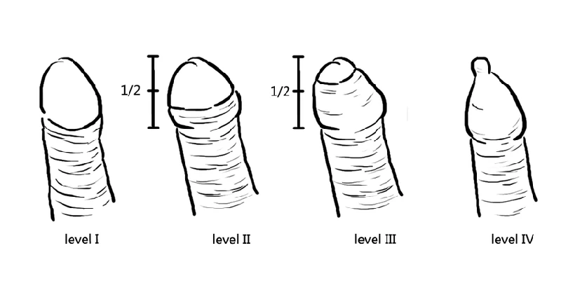 Tìm hiểu bao quy đầu như thế nào là bình thường và bất thường