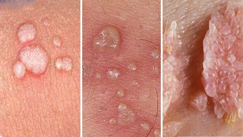 Cách chữa sùi mào gà ở vùng kín nữ hiệu quả nhất