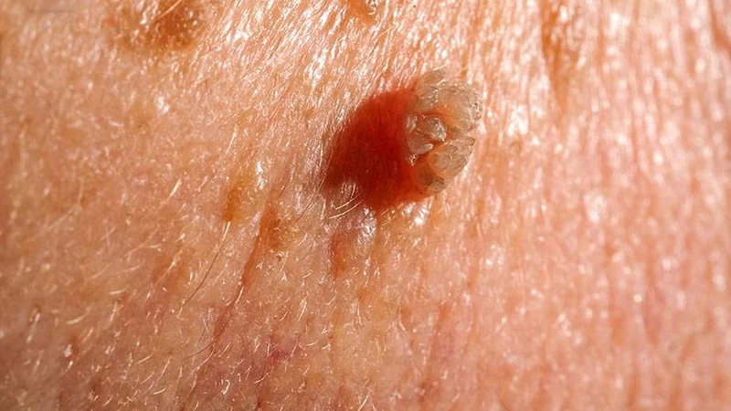 Cách chữa sùi mào gà ở nữ có những phương pháp nào?