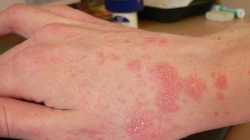 Cách chữa viêm da cơ địa hiệu quả từ lá khế