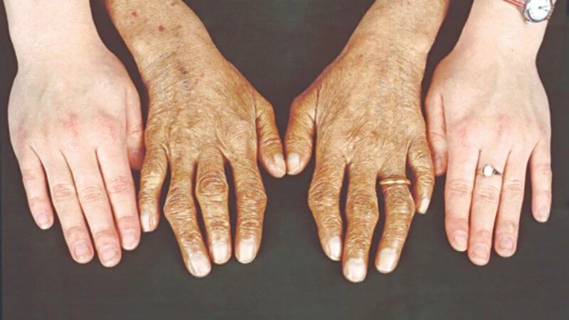 Cách đào thải sắt ra khỏi cơ thể hiệu quả