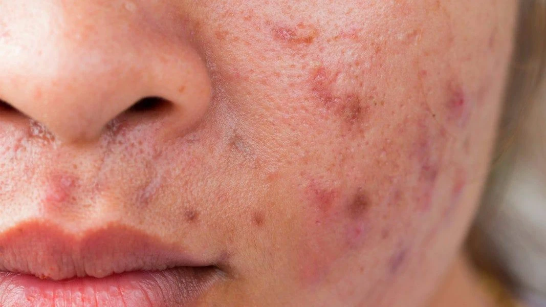 Breakout là gì và tầm quan trọng trong đầu tư tài chính